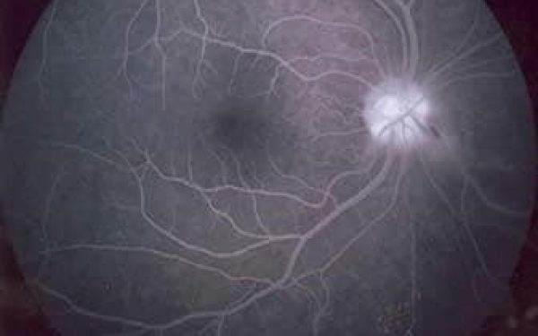 Retina durante gli effetti di una Fluorangiografia